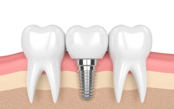 dv-cay-ghep-implant-1